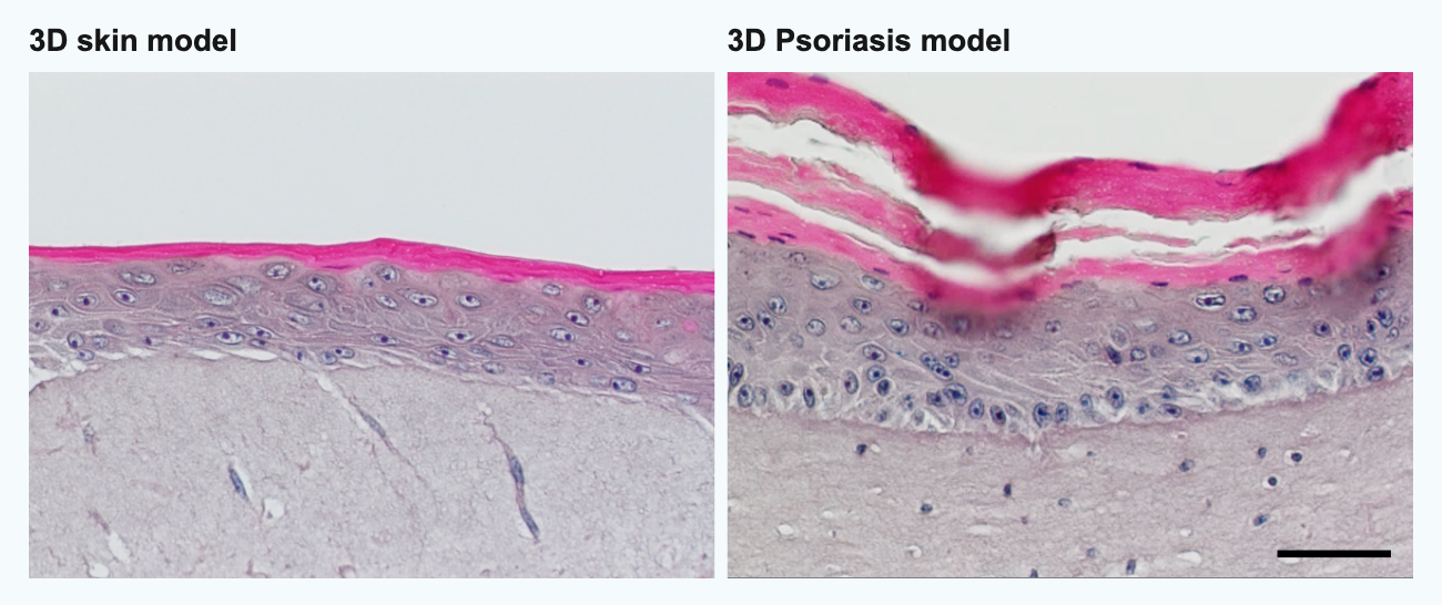 3D in vitro psoriasis model 3D in vitro psoriasis model. You can see the typical disordered keratinization (pink) and thickening (acanthosis) of the epidermis. Bar = 75 µm